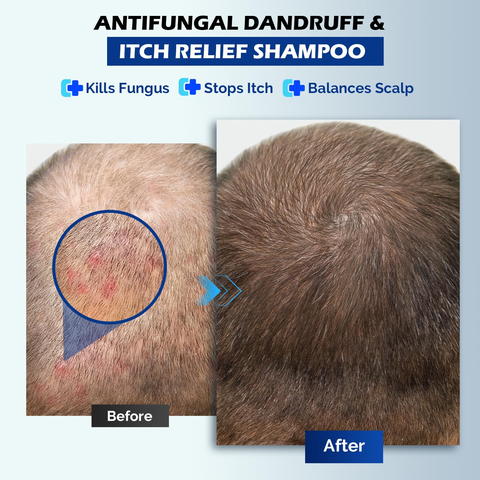 Antifungal Psoriasis Shampoo for Seborrheic Dermatitis, Folliculitis & Scalp Psoriasis, Anti-Dandruff Shampoo for Men & Women, Relieves Scalp Itching, Dryness, Sulfate & Paraben-Free, 10.1 Fl Oz-Fresh - Image 5
