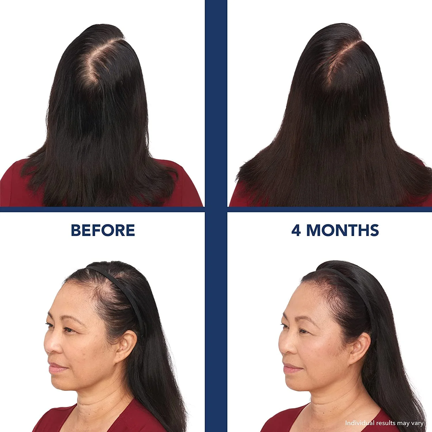 Bosley Revitalizer Flex 164 Diode 100% Laser No LEDs Hair Growth Cap (LLLT) Men and Women - Regrowth, Home Treatment, Thicker, Fuller, Healthy Hair, FDA Cleared. Large Size - Image 3