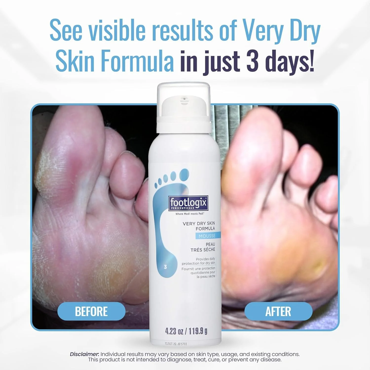 Footlogix #03 Very Dry Skin Formula - Image 3