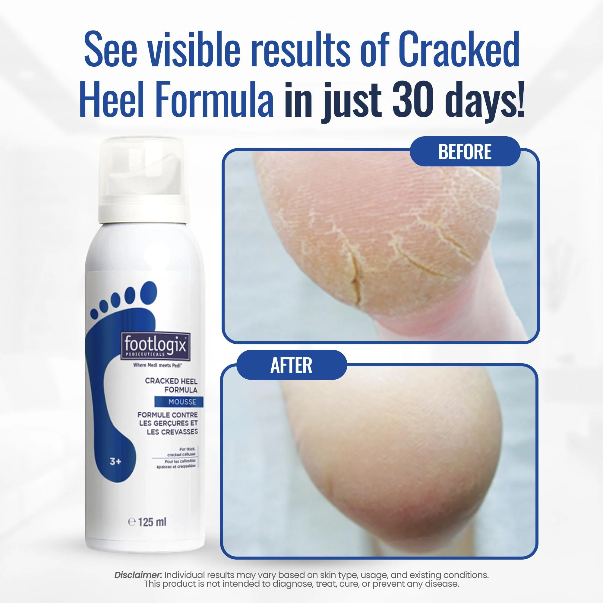 FOOTLOGIX Cracked Heel Formula, White 4.23 Ounce - Image 3