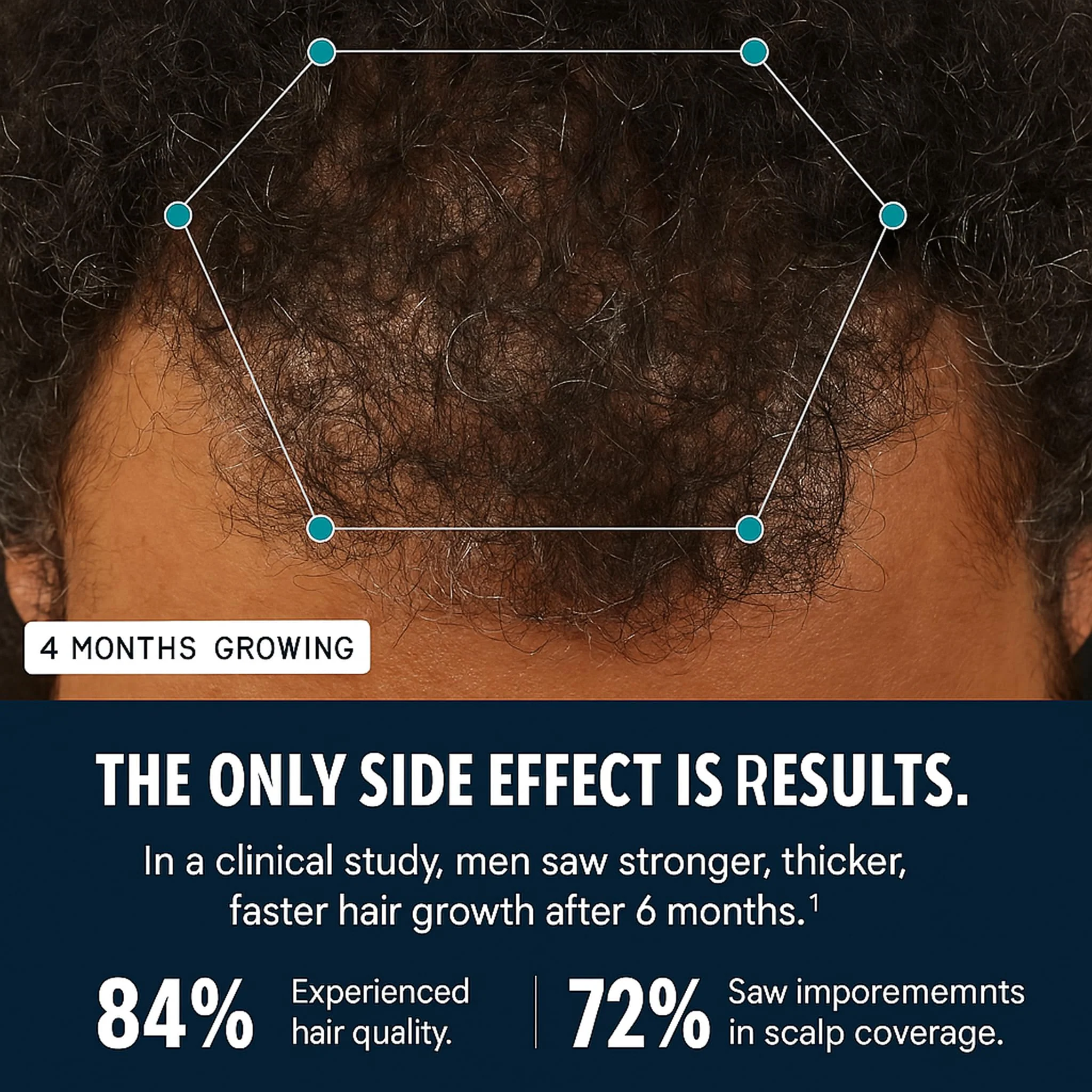 Hairfol Men's Hair Growth Supplement – Clinically Tested Hair Growth Vitamins for Men, Thicker Hair & Scalp Coverage, Hair Regrowth Support for Men – Stronger, Fuller Hair – 1 Month Supply - Image 5